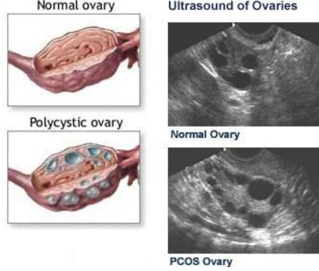 Ovarian Cysts - Dr. Elena Rodriguez