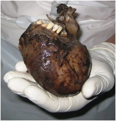 ovarian cyst with hair and teeth